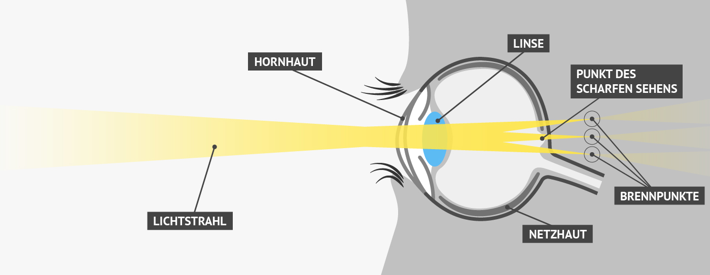 Hornhautverkrümmung | Vergleich von Fehlsichtigkeiten / Augenoperation, LASIK