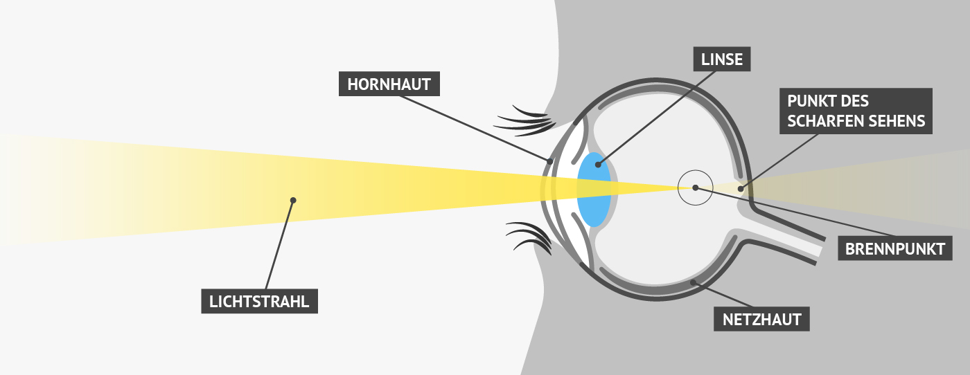 Kurzsichtigkeit | Vergleich von Fehlsichtigkeiten / Augenoperation, LASIK
