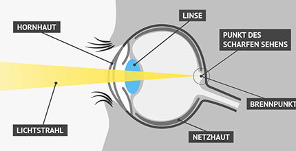 Auge & Fehlsichtigkeiten