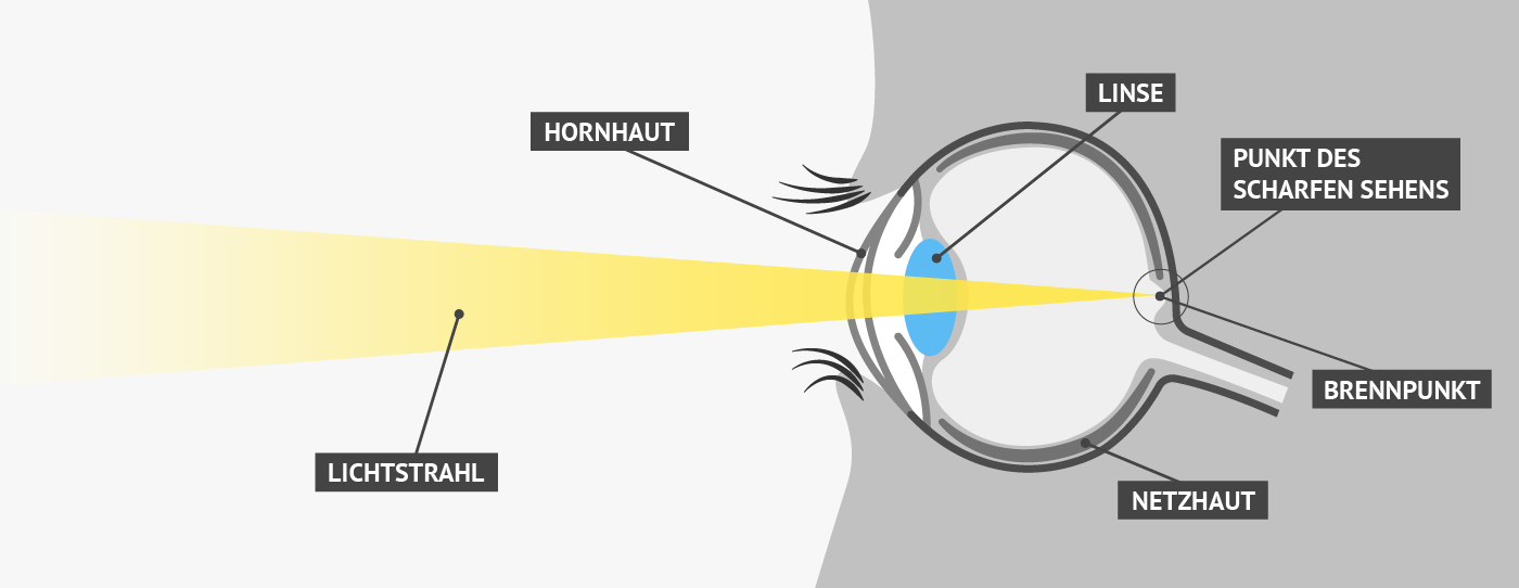 Normales Sehen | Vergleich von Fehlsichtigkeiten