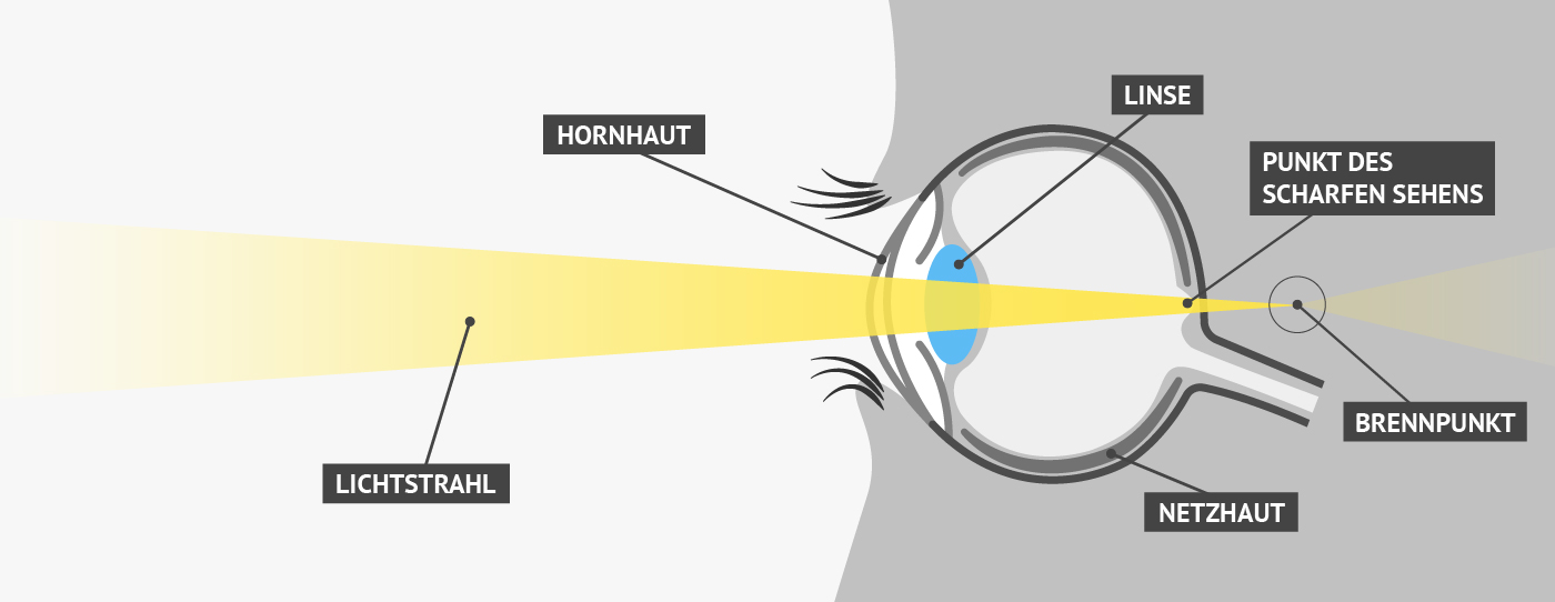 Weitsichtigkeit | Vergleich von Fehlsichtigkeiten / Augenoperation, LASIK